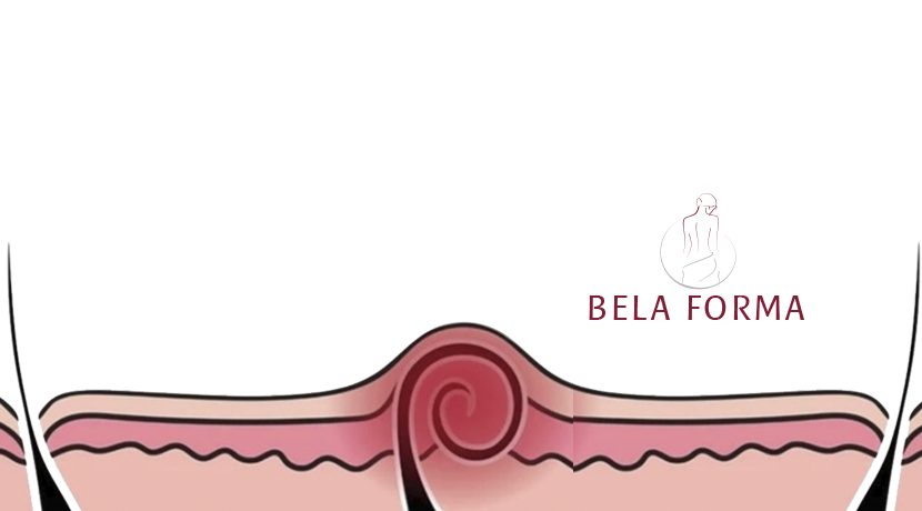 Importância da depilação a laser na virilha antes da abdominoplastia